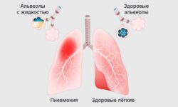 Воспаление легких, или пневмония