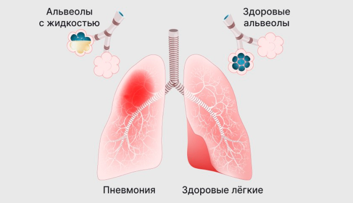 Воспаление легких, или пневмония